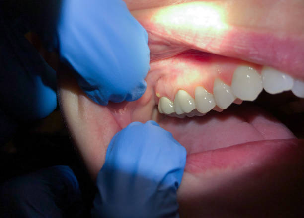 Best Emergency Wisdom Teeth Removal in Maugansville, MD